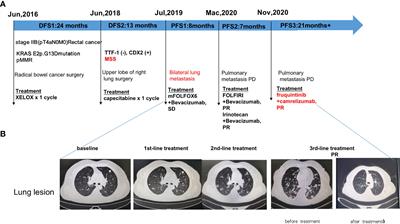 Case Report: MSS colorectal extrahepatic (non-liver) metastases as the dominant population for immunotherapy combined with multi-target tyrosine kinase inhibitors